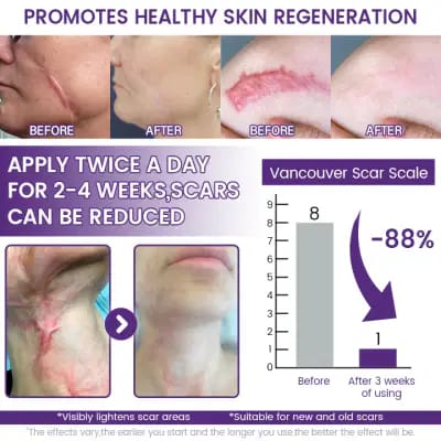 Timilk REGENSCAR Stem Cell Scar Gel | Scar Removal Gel 20g