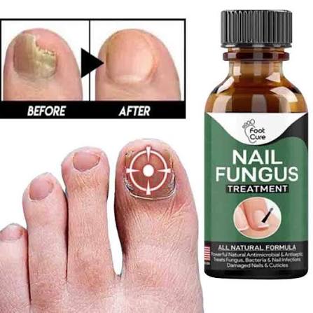 Nail Fungus Treatment Serum | Natural Formula For Finger And Toenail Care